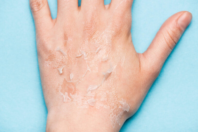 When I Rub My Skin It Rolls Off? Understanding Skin Behavior and Exfoliation