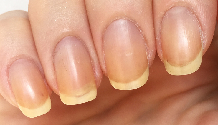 Home Remedies To Treat Orange Nails