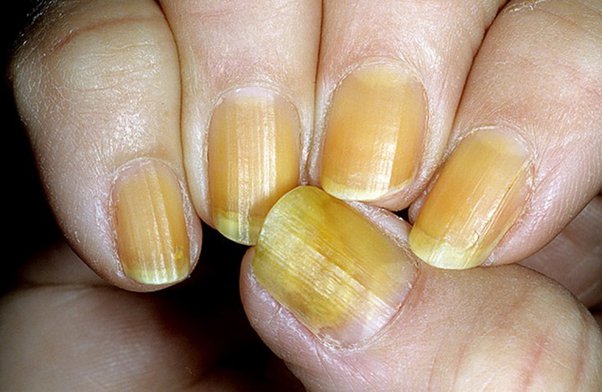 How to whiten nails instantly: Home Remedies