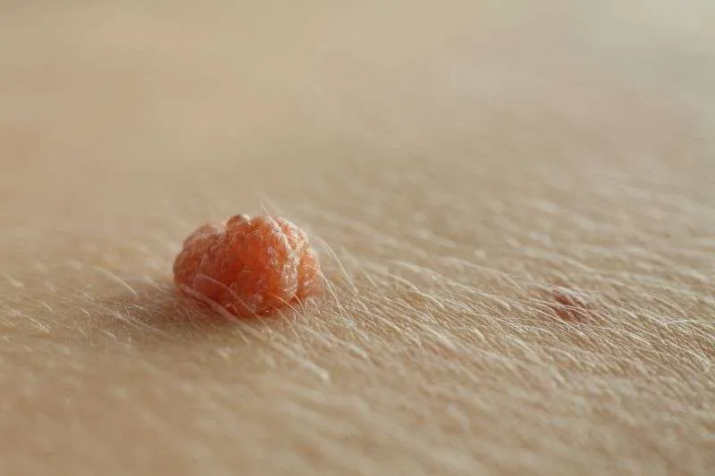 Difference between a Mole and a Skin Tag?