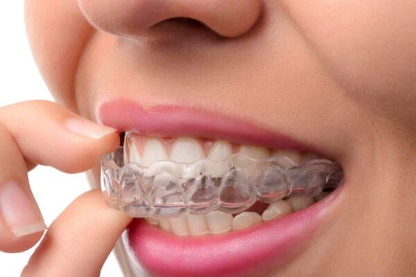 The Cost of Invisalign: Is It Worth the Investment?