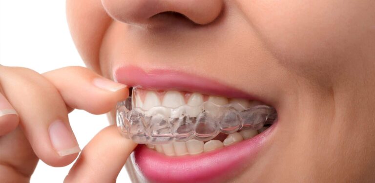 The Cost of Invisalign: Is It Worth the Investment?