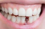 How Dental Implants Changed My Smile