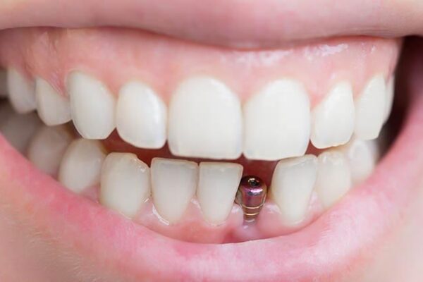 How Dental Implants Changed My Smile — and My Confidence How Dental Implants Changed My Smile