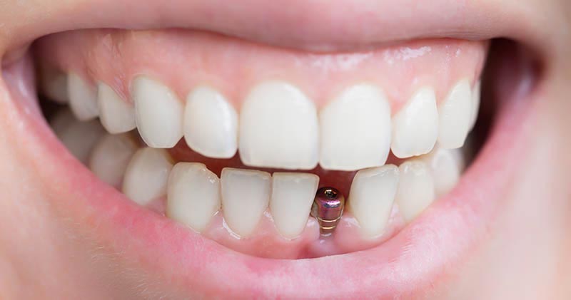 How Dental Implants Changed My Smile