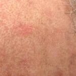 Actinic Keratosis in Primary Care: Why Early Treatment Safeguards Older Adults