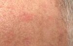 Actinic Keratosis in Primary Care: Why Early Treatment Safeguards Older Adults