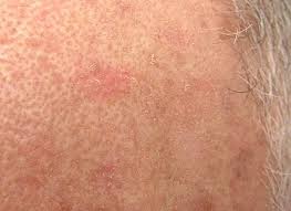 Actinic Keratosis in Primary Care: Why Early Treatment Safeguards Older Adults