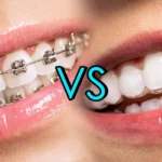 Invisalign vs Braces