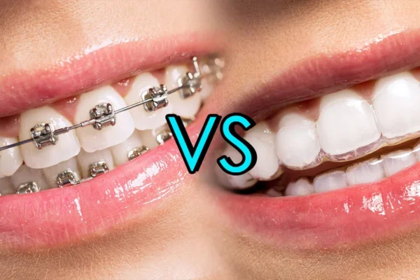 Invisalign vs Braces