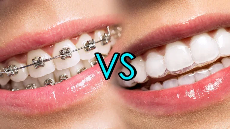 Invisalign vs Braces — Which Is Better for London Patients?