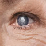 GERIATRICS Cataract Symptoms and Conditions