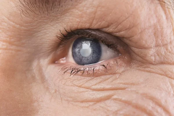 GERIATRICS Cataract Symptoms and Conditions