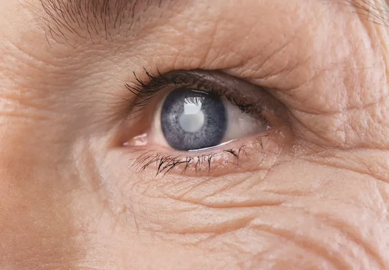 GERIATRICS Cataract Symptoms and Conditions