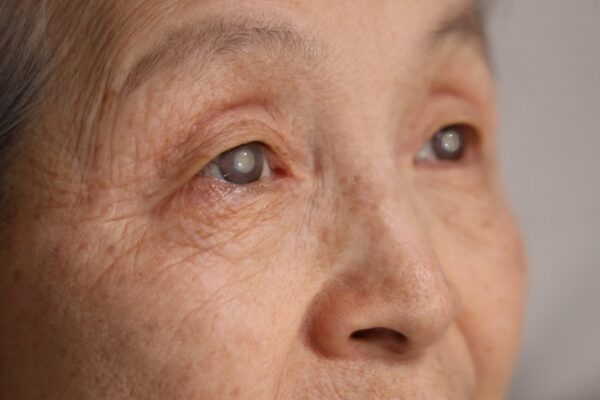 When Vision Starts to “Change”: Understanding Geriatric Cataract Symptoms and Conditions